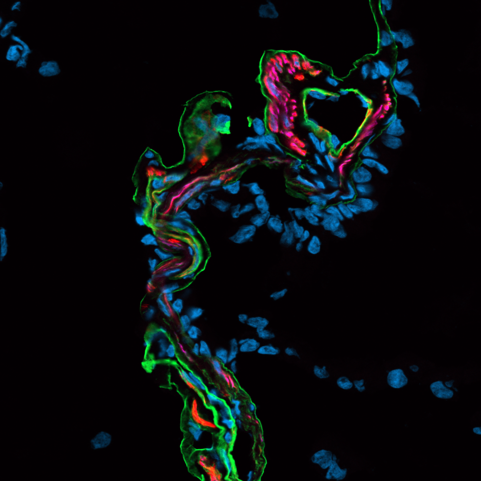 Immunofluorescence d’un bord de kyste de type CPAM2. 